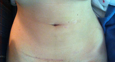 kidney donor organ donation surgery recovery scar