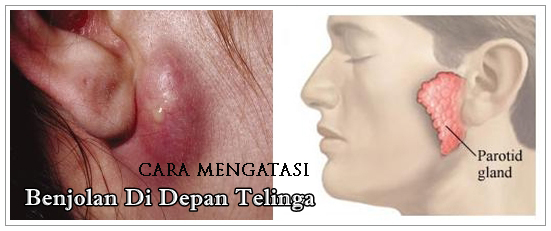 Cara Merawat Benjolan Di Depan Telinga Kanan Secara Semulajadi