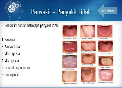 Penyakit atau gangguan pada lidah - berbagaireviews.com