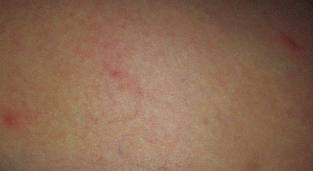 pimply rash