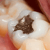 The Diseases Connected to Mercury Fillings