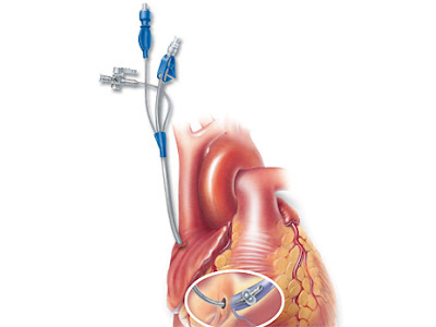Cardioplegia Types, Mechanism, Antegrade, Retrograde Cardioplegia