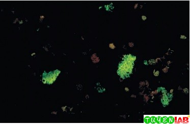 Cat Scratch Fever Subclinical Cat Scratch Fever Subclinical