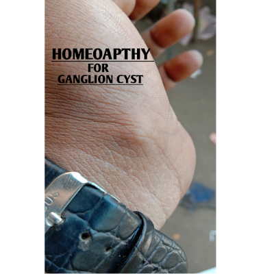 Homeopathy for ganglion cyst