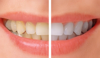 teeth whitening