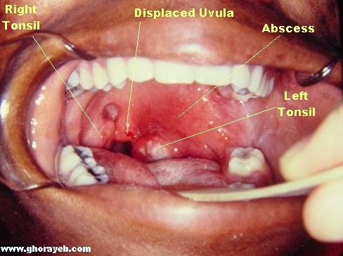Hasil gambar untuk abses peritonsil