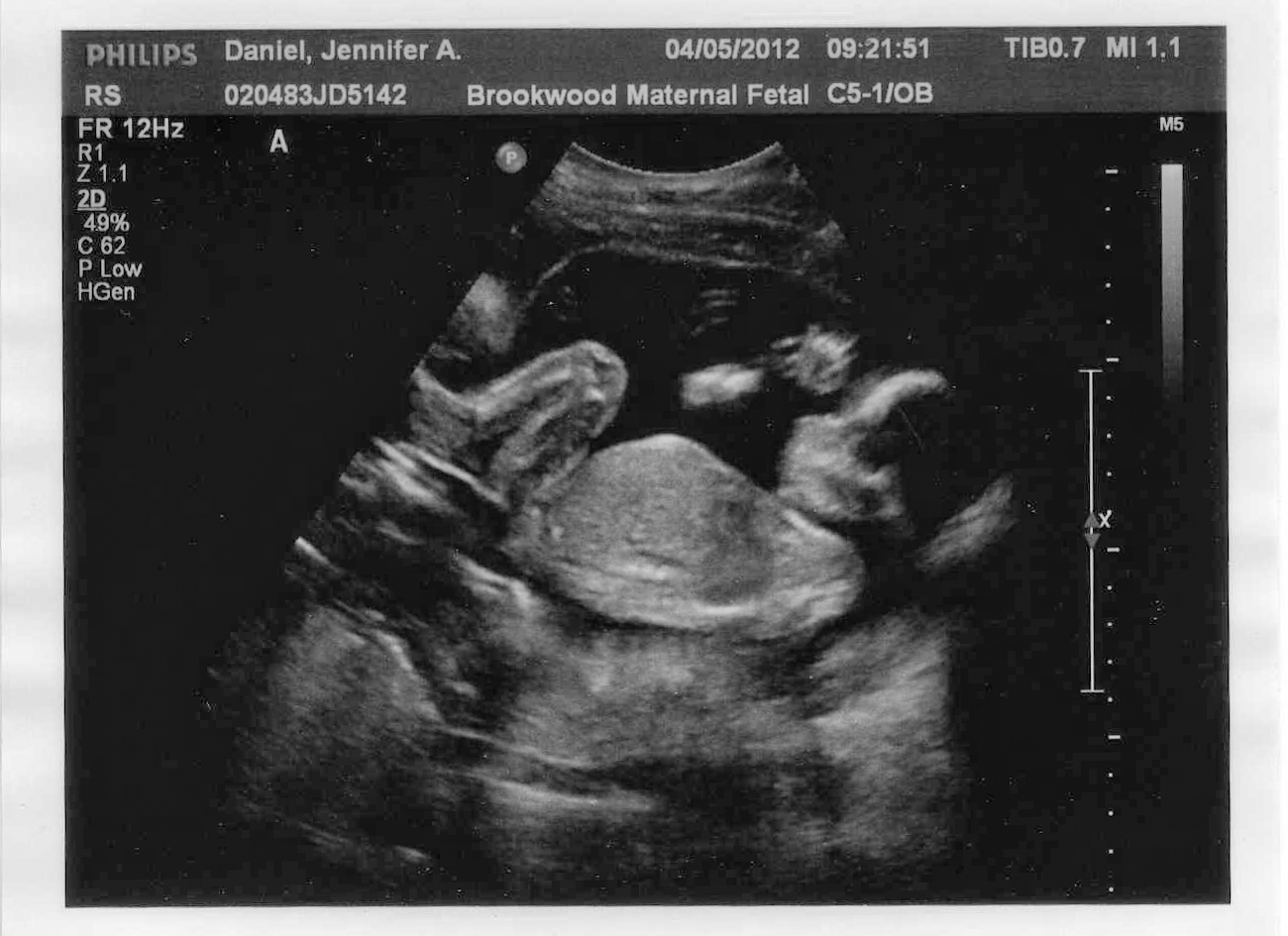 In the Daniel's Den 20 Weeks Ultrasound
