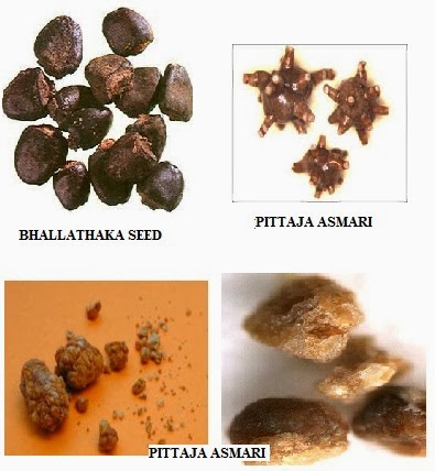 treatments in ayurveda my clinical experiences urinary calculi urinary stones