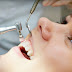 Có nên tẩy trắng răng cho răng sâu không?