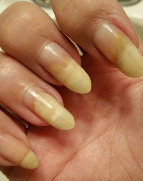 Сыворотка онихолизис отзывы. Длинные желтые ногти онихолизис. Жёлтые ногти на руках и пустые.
