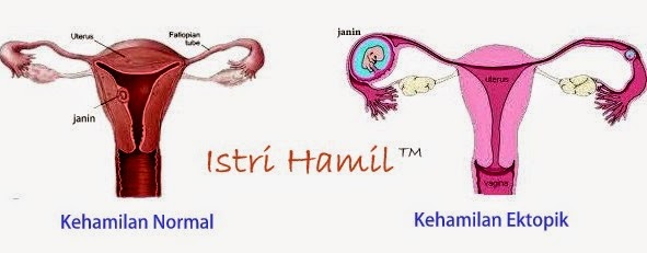 kehamilan ektopik