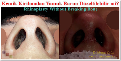 Yamuk burun tedavisi - Eğri burun tedavisi - Eğik burun ameliyatı - Kemik kırmadan burun estetiği - Burun ucu estetiği - Burun kemeri törpüleme - Kıkırdak macunu ile yamuk burun düzeltme - Eğri burun ameliyatı izle - Yamuk burun ameliyatı - Burun ucu ameliyatı - Rhinoplasty without breaking bone - Rhinoplasty in istanbul - Tip plasty in istanbul Yamuk burun tedavisi - Eğri burun tedavisi - Eğik burun ameliyatı - Kemik kırmadan burun estetiği - Burun ucu estetiği - Burun kemeri törpüleme - Kıkırdak macunu ile yamuk burun düzeltme - Eğri burun ameliyatı izle - Yamuk burun ameliyatı - Burun ucu ameliyatı - Rhinoplasty without breaking bone - Rhinoplasty in istanbul - Tip plasty in istanbul