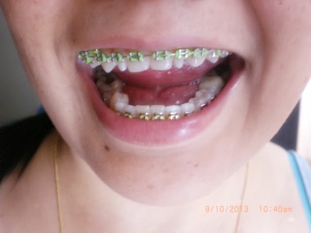 My Braces Elicy: Braces on May-Sept 2013