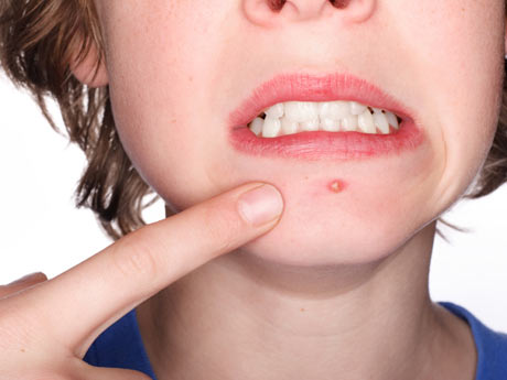 Todo lo que necesitas saber sobre el tratamiento de las cicatrices del acné
