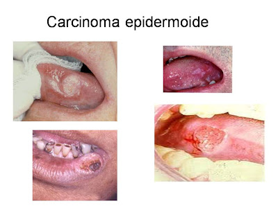 Carcinoma epidermoide boca