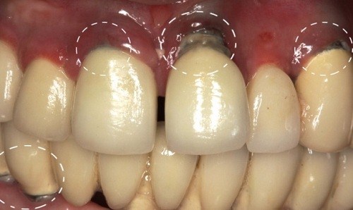 PHỤC HÌNH RĂNG SỨ TRÊN IMPLANT QUÁ SỚM VÀ NHỮNG TÁC HẠI -12
