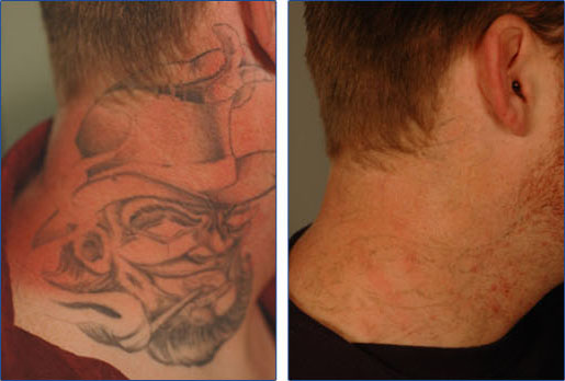 Laser Tattoo Removal Cost  Best 4U