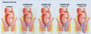 obat ambeien berdarah