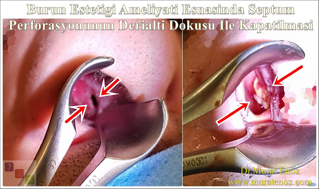 Deri altı dokusu ile septum perforasyonu tamiri - Deri altı dokusu ile septum perforasyonu ameliyatı - Septum perforasyonu tedavisi - Nazal septum perforasyonu operasyonu - Açık teknik septum perforasyonu ameliyatı - Açık teknik septum perforasyonu onarımı - Burun estetiği ile birlikte septum perforasyonu kapatılması - Burun septumunda delik kapatılması - Burun septum perforasyonu ameliyatı - Septum perforation closure in Istanbul - Septum perforation closure with under skin tissue - Closure of nasal septal perforations using under skin tissue - Combining rhinoplasty with septal perforation repair Deri altı dokusu ile septum perforasyonu tamiri - Deri altı dokusu ile septum perforasyonu ameliyatı - Septum perforasyonu tedavisi - Nazal septum perforasyonu operasyonu - Açık teknik septum perforasyonu ameliyatı - Açık teknik septum perforasyonu onarımı - Burun estetiği ile birlikte septum perforasyonu kapatılması - Burun septumunda delik kapatılması - Burun septum perforasyonu ameliyatı - Septum perforation closure in Istanbul - Septum perforation closure with under skin tissue - Closure of nasal septal perforations using under skin tissue - Combining rhinoplasty with septal perforation repair