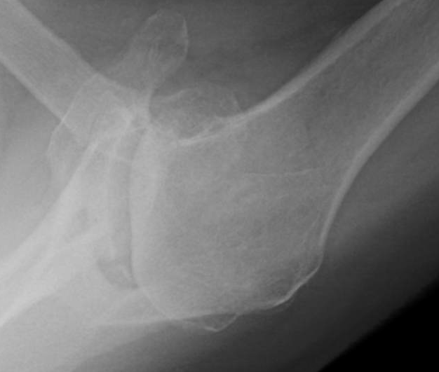 Shoulder Arthritis / Rotator Cuff Tears causes of shoulder pain