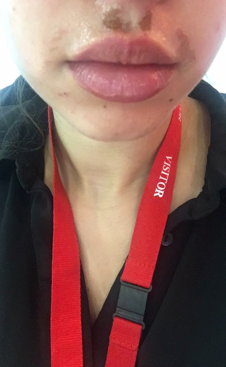 Comfortable in my own skin // how to treat wax burns Blogged by Mays