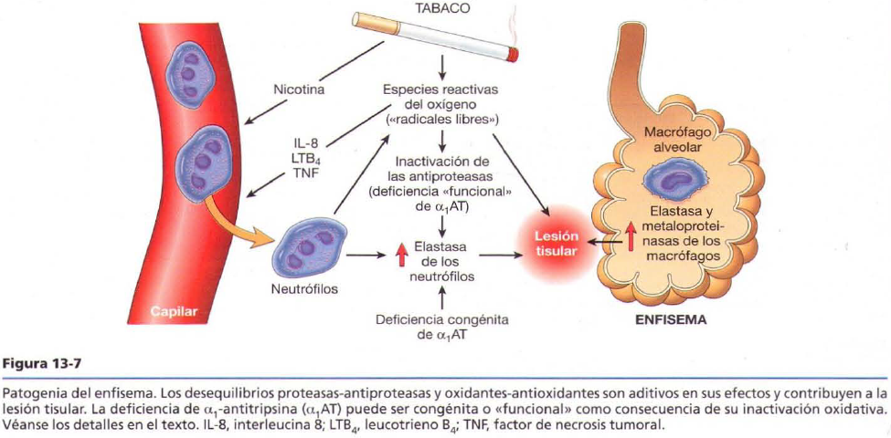 Agustina Ocampo - Patología B 2014: EPOC (Enfisema y Bronquitis crónica)