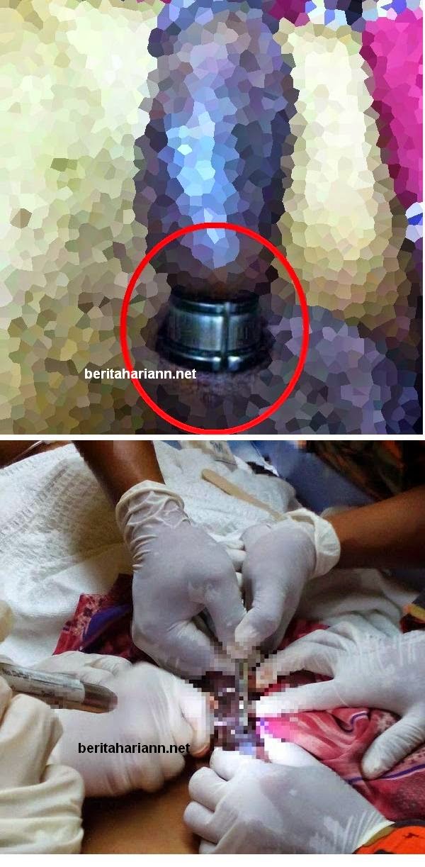 Gambar-Gambar Bomba Keluarkan Cincin Tersekat Pada Batang Lelaki