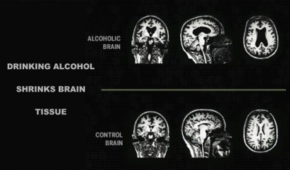 Alcohol Causes The Brain To Shrink