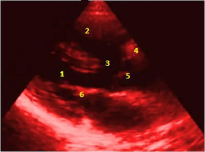 Tetralogy of Fallot echocardiogram-cardiology book-congenital heart disease