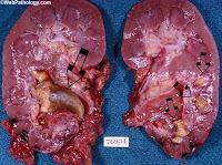"calculo-litiasis-renal-2"