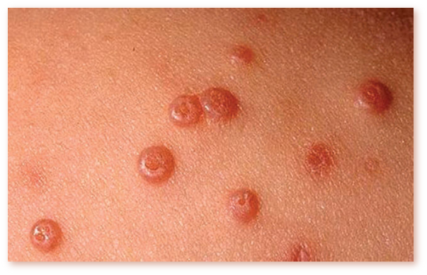 hpv papiloame