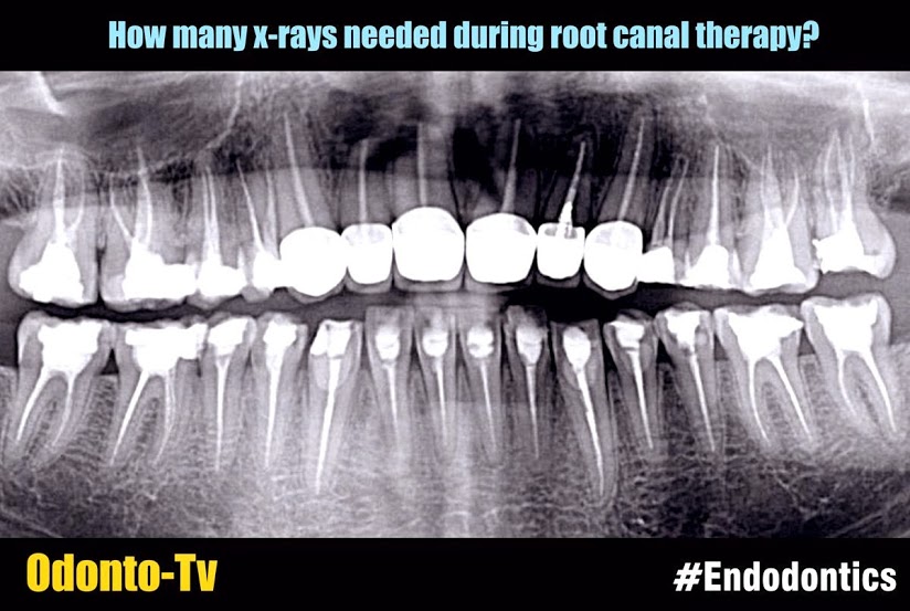 ENDODONTICS How many xrays needed during root canal therapy?