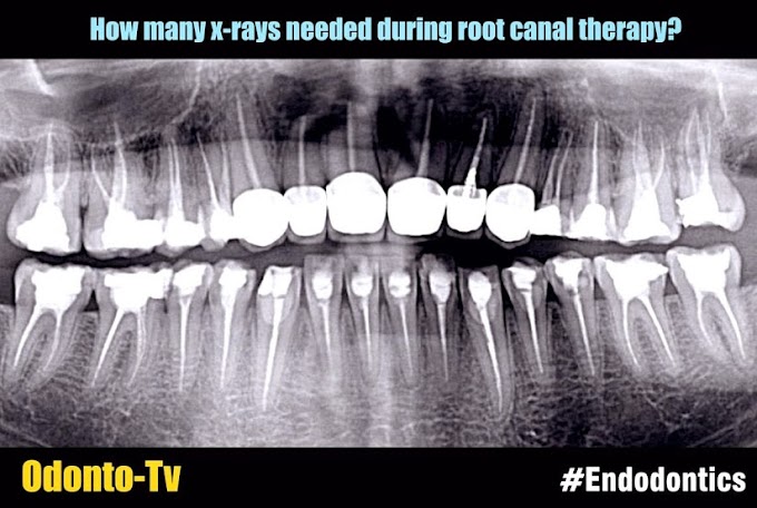 ENDODONTICS: How many x-rays needed during root canal therapy?