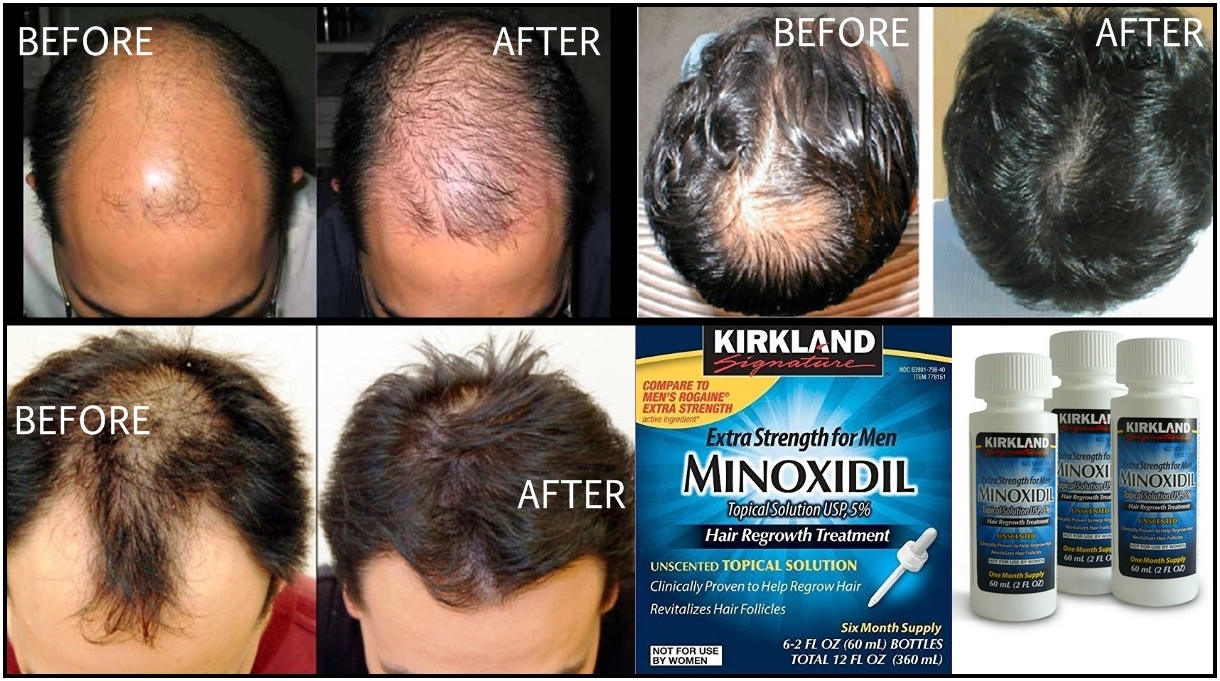 Tips Alami Mengatasi Kebotakan Dan Rambut Rontok Pada Pria Tips Alami Mengatasi Kebotakan Dan Rambut Rontok Pada Pria
