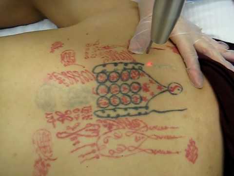 The Tattoo World : Laser Tattoo Removal Cost
