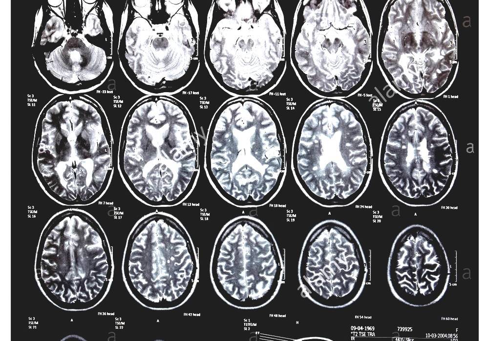 Computed Tomography Of The Head Cat Scan Of Head