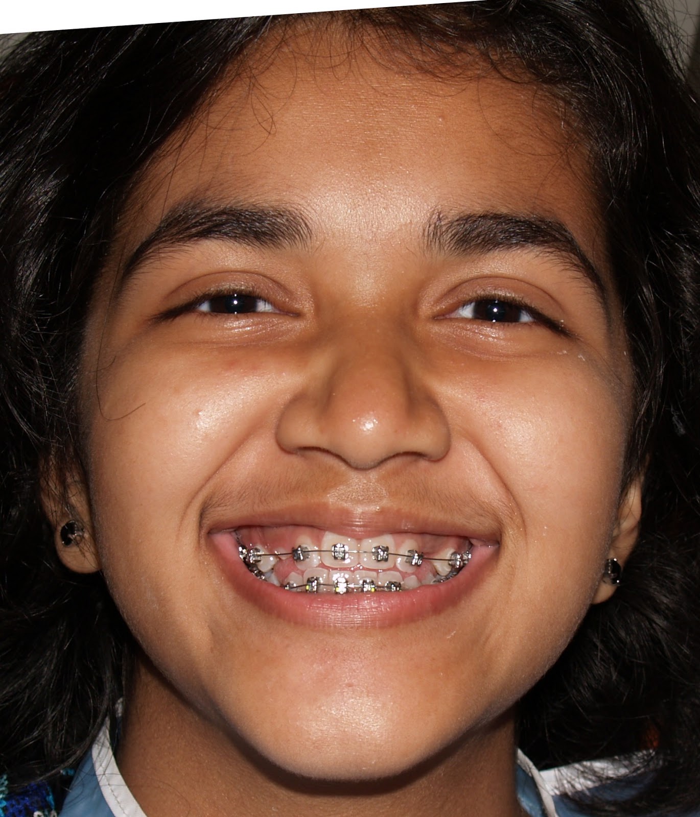 Quick, Accelerated Braces treatment with DAMON SYSTEM