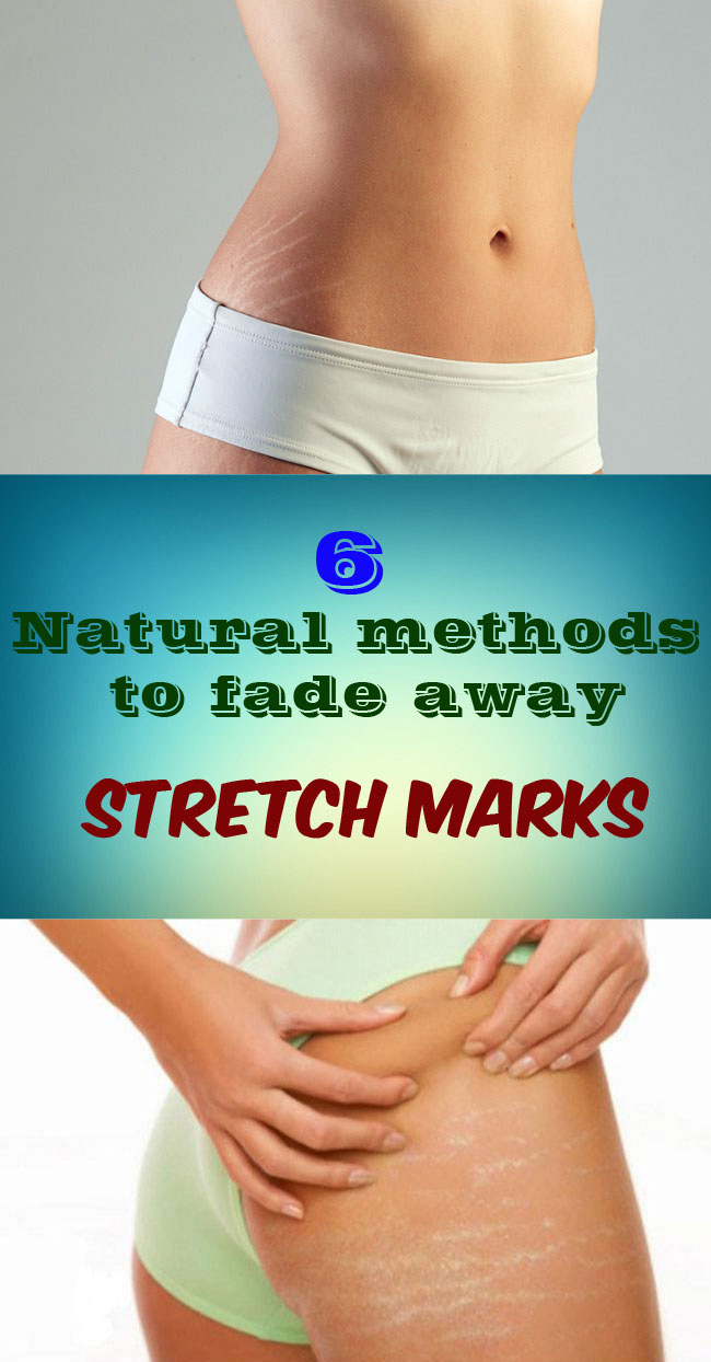 6 Natural remedies to fade away Stretch marks