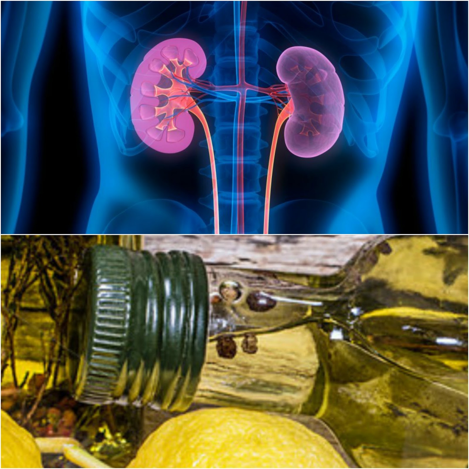 Remove Your Kidney Stones In Only 3 Days With This Traditional Remedy