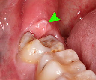 Bác sĩ nha khoa || Nhổ răng khôn: Răng khôn hay răng dại ?