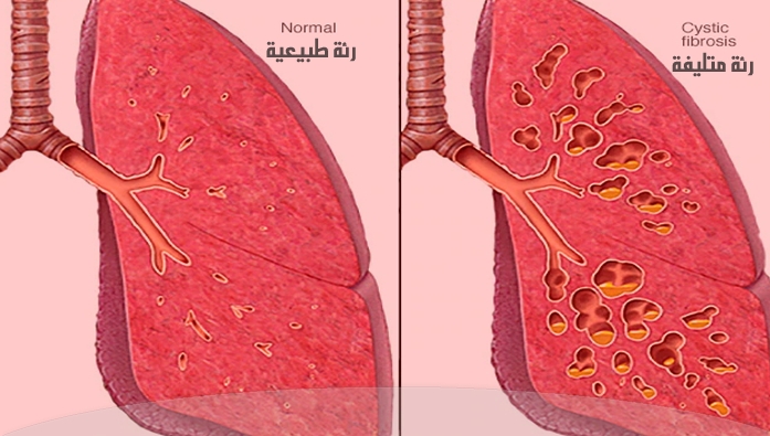 التليف الكيسي التليف الكيسي الأعراض والأسباب وطرق العلاج