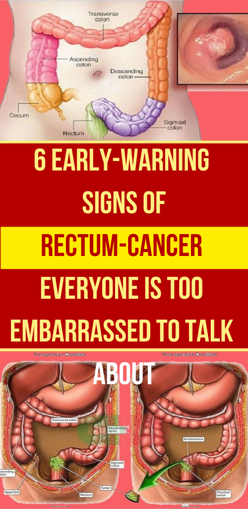 What Are The Warning Signs Of Rectal Cancer What Are The Symptoms Of