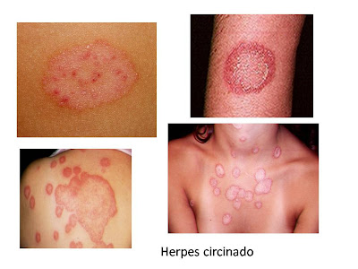 Herpes circinado