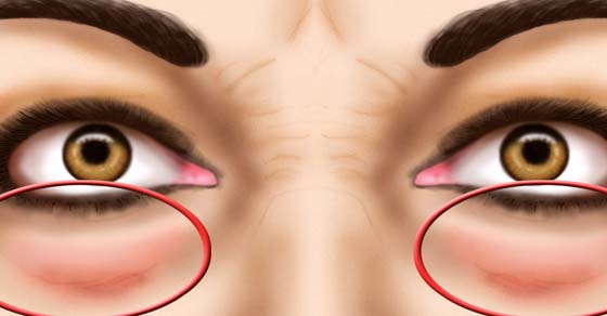 Que hacer para que no había arrugas bajo los ojos