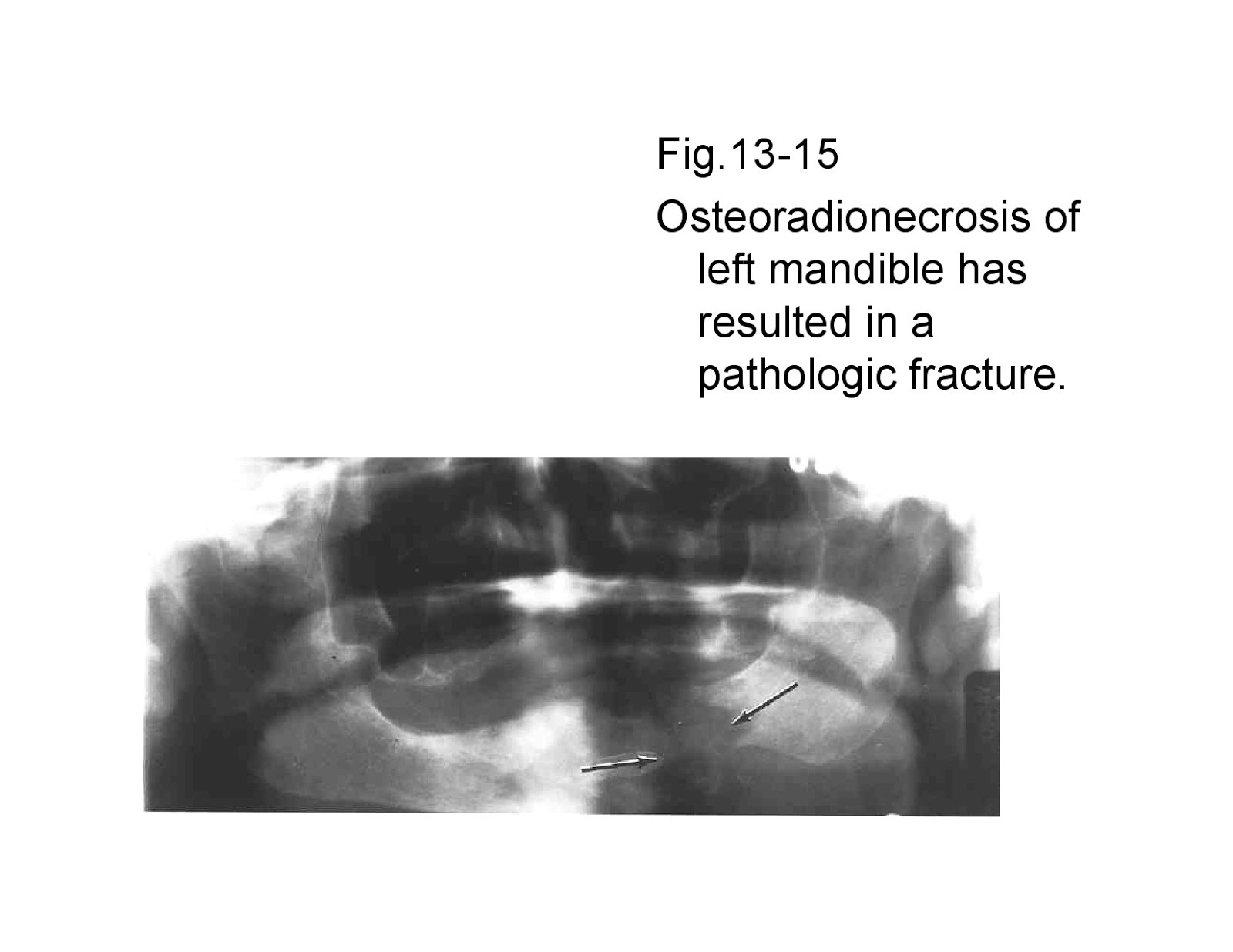 Dentistry and Medicine Osteomyelitiswith Radiological features