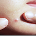 9 Things You Should Know About How Pimples Are Formed