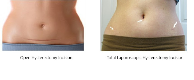 Best Gynaecologist in Rohini describes about Laparoscopic Hysterectomy!