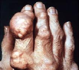 artrite cristalina