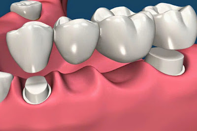 Ưu điểm của phương pháp cầu răng sứ là gì?