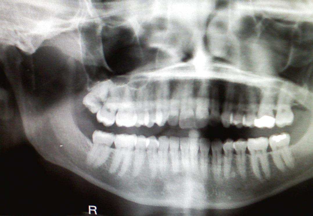 Frequent Exposure to Dental X Rays May Lead To Brain Tumors EBLOGGR